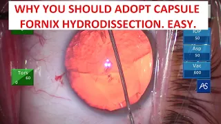 Why You Should Adopt Capsule Fornix Hydrodissection. Illustration of Easy Fluid Wave Propagation.