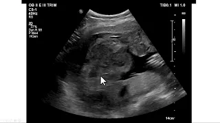 Descolamento prematuro da placenta. Achados ultrassonográficos e operatórios.