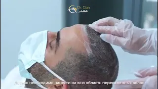Процесс отшелушивания корочек, на 10й день после трансплантации волос - Dr Can Aesthetic