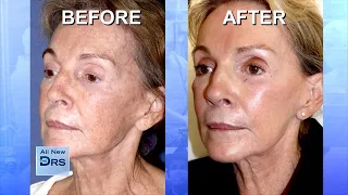 Chemical Peels, Microdermabrasion & Lasers Could Get You Beautiful Skin