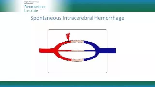 Management Principles for Spontaneous Intracerebral Hemorrhage