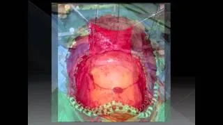 Modified one-piece extended transbasal approach for translamina terminalis resection