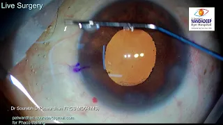 Toric IOL in small pupil Mark extension technique by Dr Sourabh Patwardhan