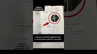 Patient with Optic Atrophy caused by glaucoma got vision acuity and visual field improvement