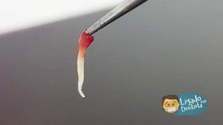 Tratamento de Canal - Aliviando a dor de dente - Remoção da Polpa