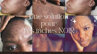 une solution pour ton acné, tâches Noirs