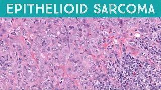 Epithelioid sarcoma explained in 5 minutes (pathology dermpath dermatopathology dermatology)