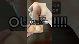 ABSCESS ON YOUR BUTT | PILONIDAL CYST 😱😫