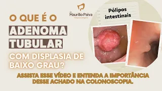 Colonoscopia com adenoma tubular com displasia de baixo grau - é grave?