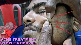 Acne treatment / Pimple Removal | Head massage with Neck & Ear cracking | ASMR