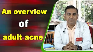 An overview of adult acne by Dr.Amit Vij | पिंपल के प्रकार, कारण और उपाय