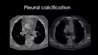 Imaging of Pleural &Chest wall lesions   Prof Dr  Mamdouh Mahfouz In Arabic