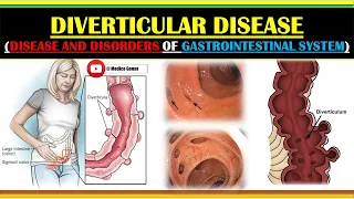 DIVERTICULAR DISEASE | DIVERTICULOSIS | DIVERTICULITIS | DIVERTICULA | DIVERTICULAM | CAUSES | NOTES