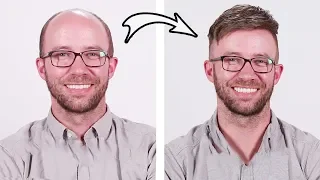 Bald Man Tries Semi-Permanent Hair Piece