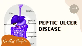 Peptic ulcer disease | H. pylori gastritis | Pathogenesis | Morphology | Clinical features