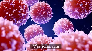 Regenerative medicine for meniscus tear