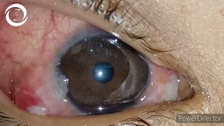 Limbal Vernal Keratoconjunctivitis