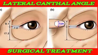 How to Reformation of the Lateral Canthal Angle #ocns #aao #ophthalmology