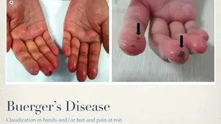 Buerger's Disease | Mini-lesson with Gillian Marsollier