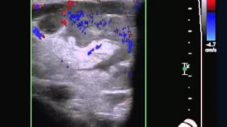 SonoSim Ultrasound Video Challenge - Soft Tissue