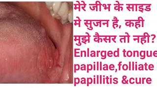 मेरे जीभ के साइड मे सुजन है, कही मुझे कैसर तो नही?Enlarged tongue papillae,folliate papillitis &cure