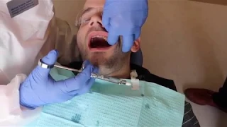 Local Anesthesia Techniques: Maxillary Injections