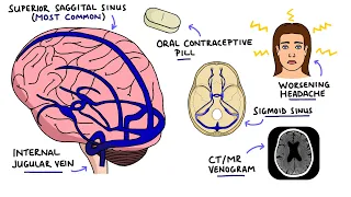 Cerebral Venous Sinus Thrombosis (CVST) | With Dural Venous Sinuses Anatomy