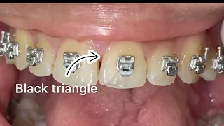 Black tringle management, treatment of black gaps between the teeth with fine enamel recontouring