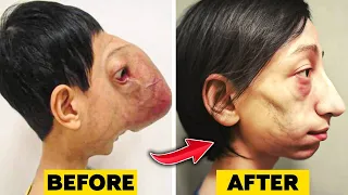 10 Kids Who Had Extreme Plastic Surgery | Before and After Plastic Surgery