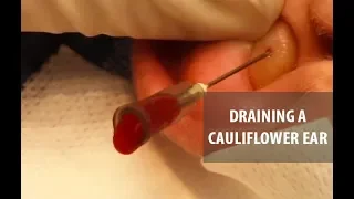Draining a Cauliflower Ear | Dr. Derm
