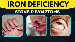 Symptoms of Iron deficiency | Anemia Symptoms | Weird symptoms of Iron Deficiency