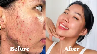 (ENG SUB) HOW I GOT RID OF MY ACNE, SCARS, TEXTURE & HYPERPIGMENTATION  *not sponsored*