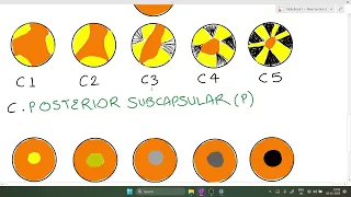 Classification of Cataract-LOCS III System