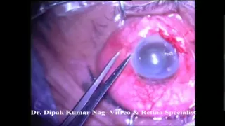 Intra Vitreal injection for Endophthalmitis