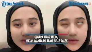 Viral Gegara Sering Kena Kipas Angin, Wajah Wanita ini Alami Bells Palsy