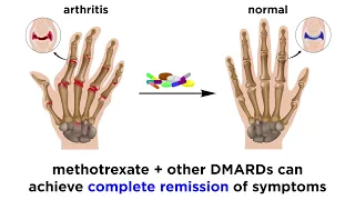 Methotrexate (Rheumatoid Arthritis Drug)