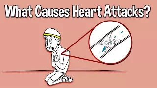What Causes Heart Attacks?