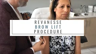 Live Revanesse Brow Lift (including Before + After) | Verso Surgery Centre