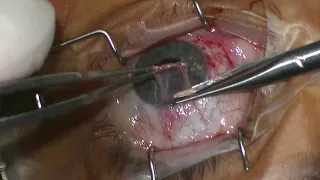 3 MInute Pterygium Surgery