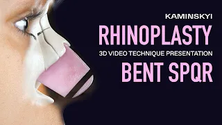 SPQR TECHNIQUE and RESULTS. Preservation rhinoplasty / KAMINSKYI