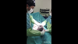 Caesarean section with twins