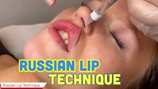 Advanced Russian Lip Filler Technique | Full treatment with Before and After