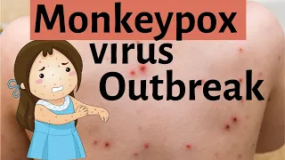 Monkeypox virus outbreak | What is monkeypox virus?