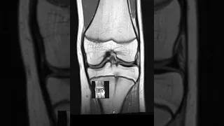 How to Read Knee MRI scan | First Look MRI