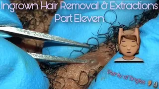 ASMR Ingrown Hair Removal & Extractions 11 🔍| Beard & Neck Area