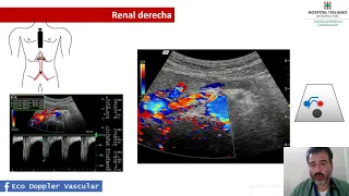 Paso a paso: ¿cómo hacer una eco doppler renal? Por el Dr. Ignacio Bluro