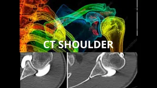طريقة عمل أشعة مقطعية على مفصل الكتف CT SHOULDER