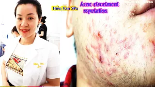 The best blackheads extractions,Acne Treatment at Hien Van Spa-390-Sú Minh Duy