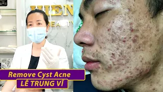 Remove Acne | Điều trị mụn hiệu quả số 1 TPHCM | Hiền Vân spa| Lê Trung Sỹ| 536