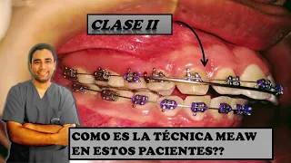 Como se Soluciona Un Paciente de Clase II 👌Con la técnica MEAW en Ortodoncia?👀